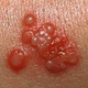 Illustration for article titled Obat penyakit herpes apotikem/em